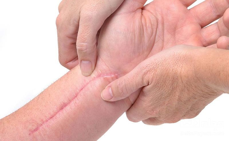 از بین بردن جای زخم