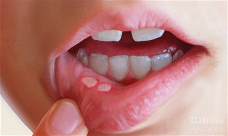 درمان سریع آفت دهان