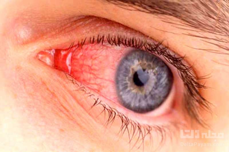 برخی عفونت های خطرناک چشمی 