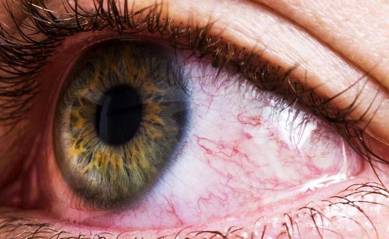 تشخیص بیماری از روی چشم