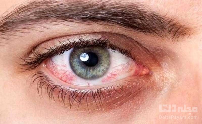 علایم خشکی فصلی چشم