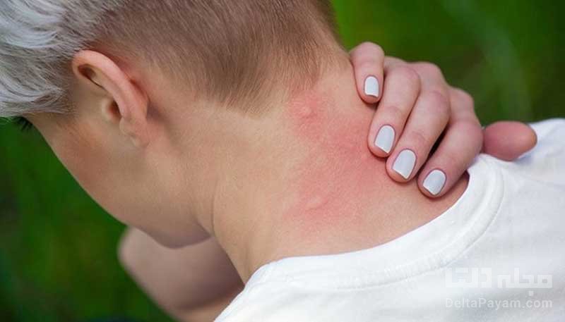 مقابله با نیش پشه