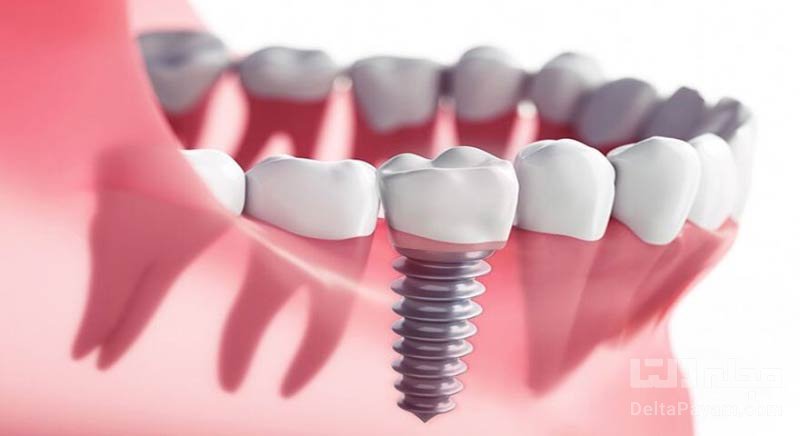 مراقبت از دندان مصنوعی و ایمپلنت چه تفاوتی دارد؟