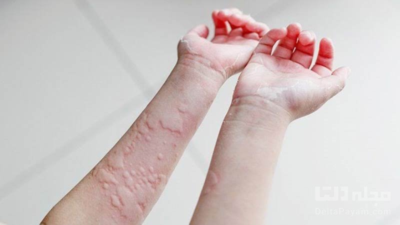 اقدامات اولیه در صورت ریختن وایتکس روی پوست