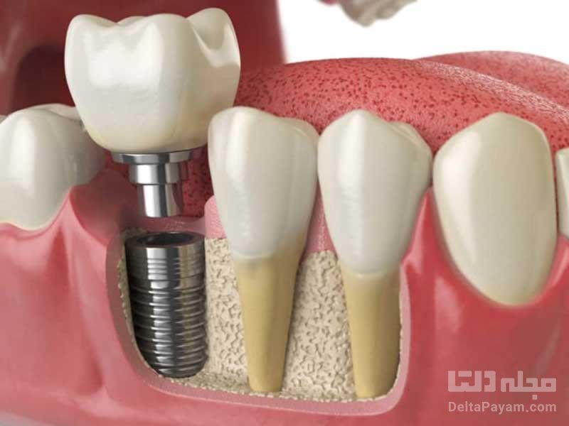 ایمپلنت دندان چه زمان پیشنهاد می‌شود؟ مزایا و عوارض آن کدامند؟