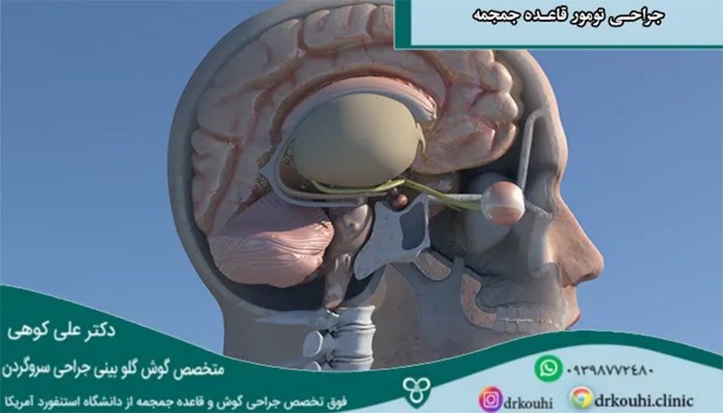 جراحی قاعده جمجمه