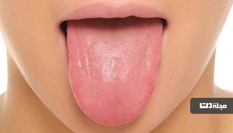 درمان خانگی سفیدی زبان