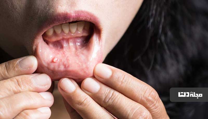 دلایل و عوامل خطرآفرین سرطان دهان چه چیزهایی هستند؟