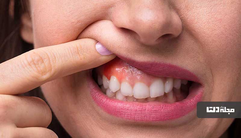 نشانه‌ها و علائم هشداردهنده سرطان دهان چه چیزهایی هستند؟