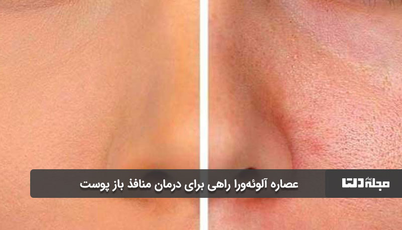 عصاره آلوئه‌ورا راهی برای درمان منافذ باز پوست